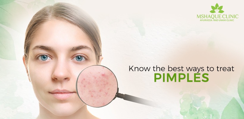 Know the best ways to treat pimples | MSHaque Clinic