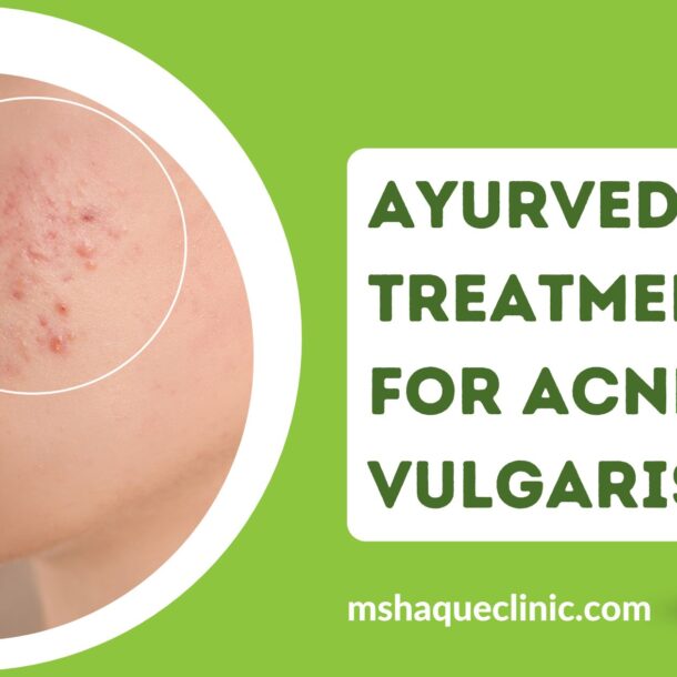 ayurvedic treatment for acne vulgaris