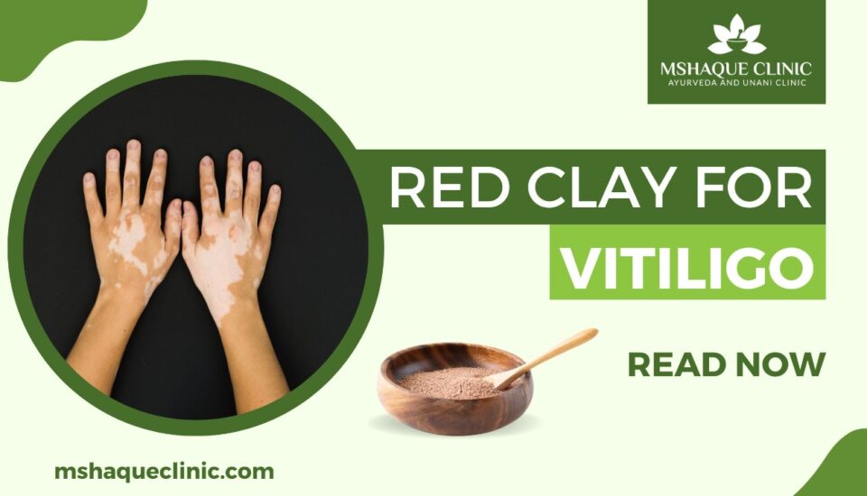 Red Clay For Vitiligo
