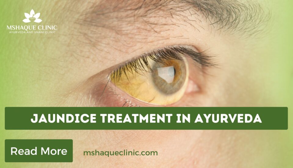 Jaundice Treatment In Ayurveda