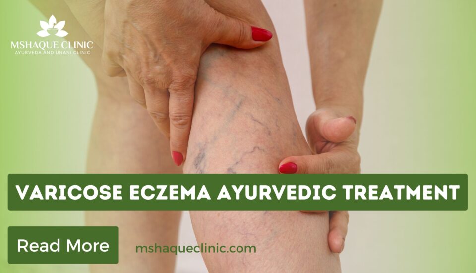 Varicose Eczema Ayurvedic Treatment