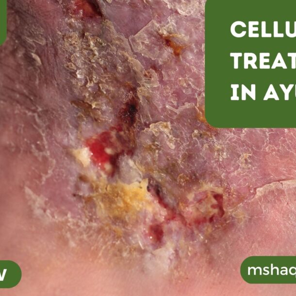 Cellulitis Treatment In Ayurveda