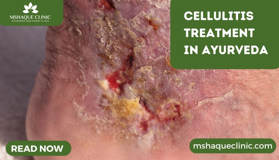 Cellulitis Treatment In Ayurveda