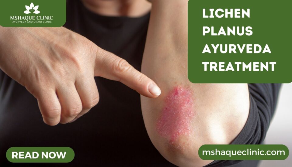 Lichen Planus Ayurveda Treatment