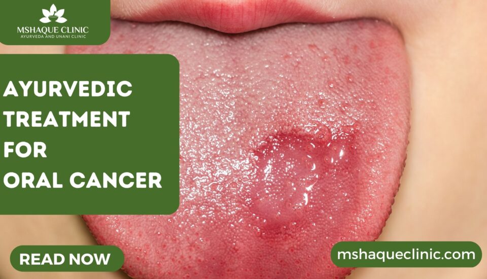Ayurvedic Treatment For Oral Cancer