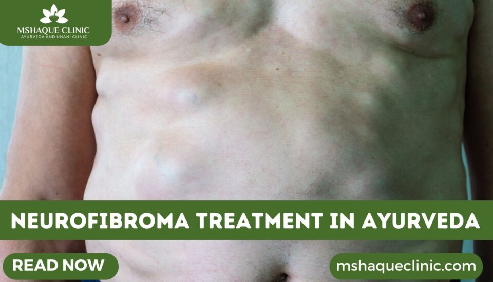 Neurofibroma Treatment In Ayurveda