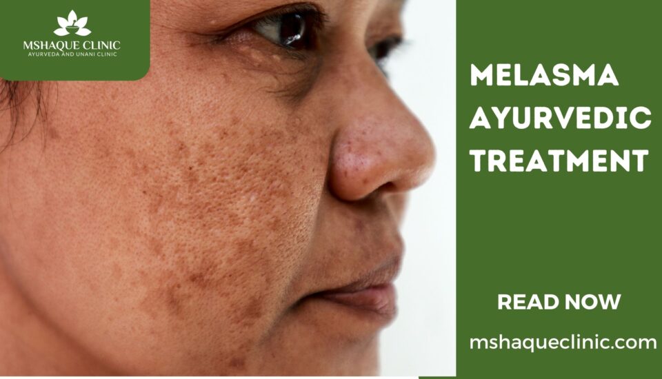Melasma Ayurvedic Treatment