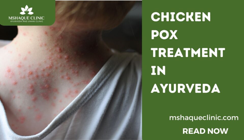 Chicken Pox Treatment In Ayurveda
