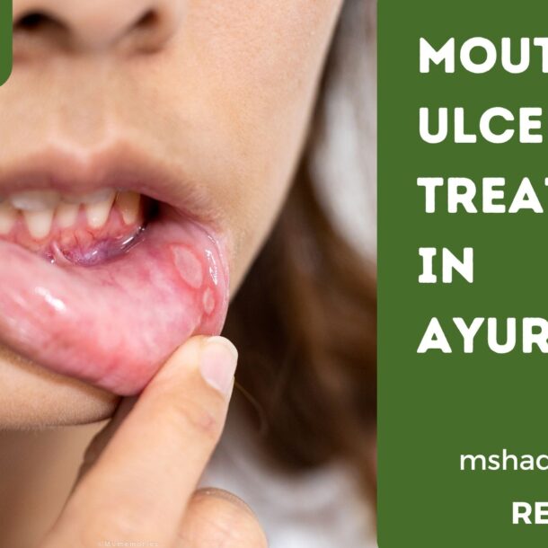 Mouth Ulcers Treatment In Ayurveda