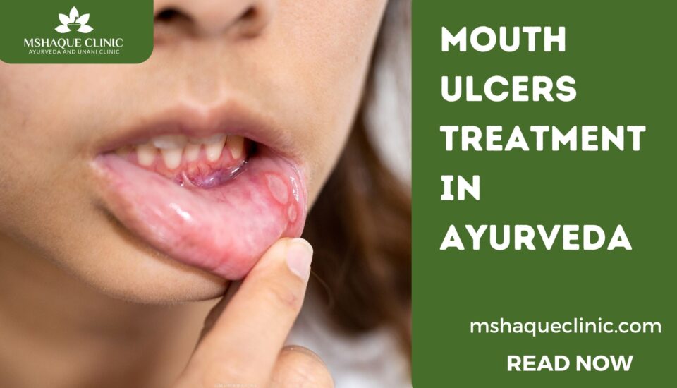 Mouth Ulcers Treatment In Ayurveda