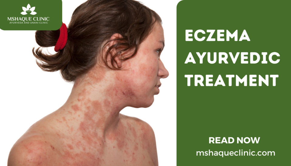 Eczema Ayurvedic Treatment