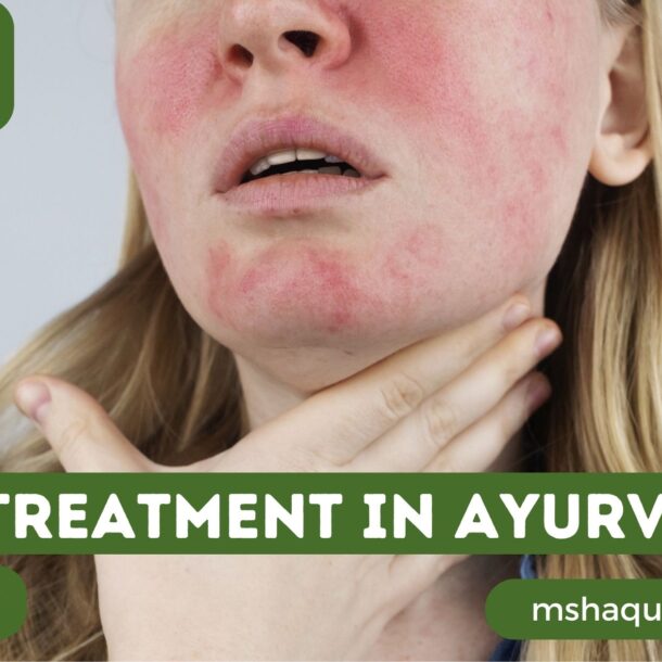 Sle Treatment In Ayurveda