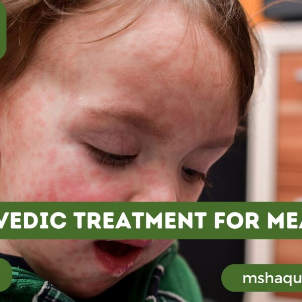 Ayurvedic Treatment For Measles