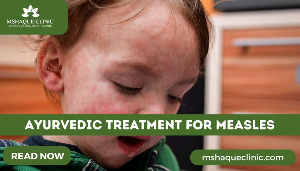 Ayurvedic Treatment For Measles