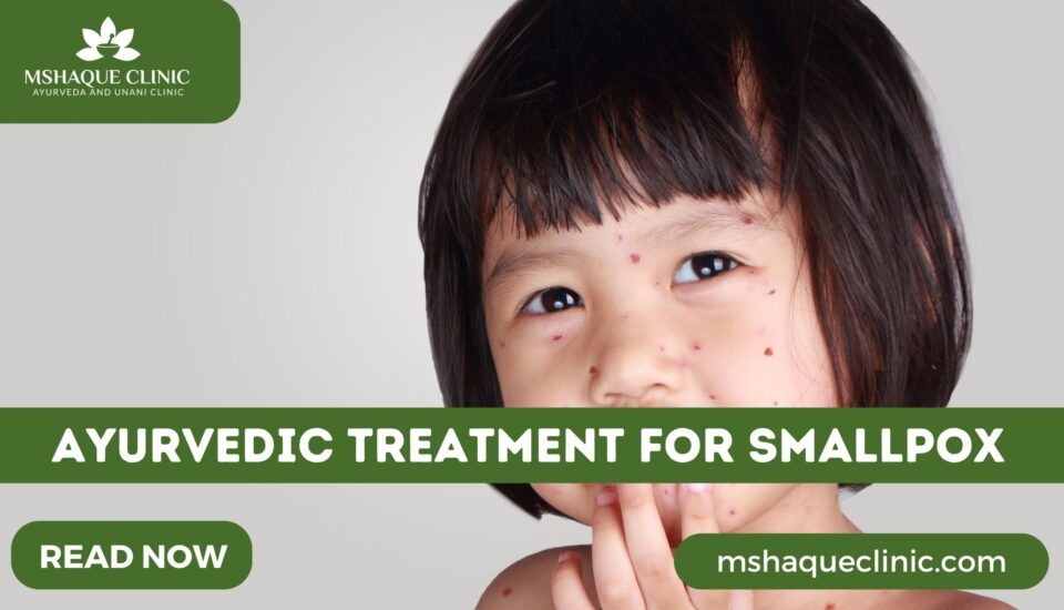 Ayurvedic Treatment For Smallpox