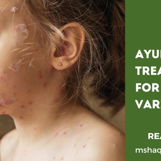 Ayurvedic Treatment For Varicella