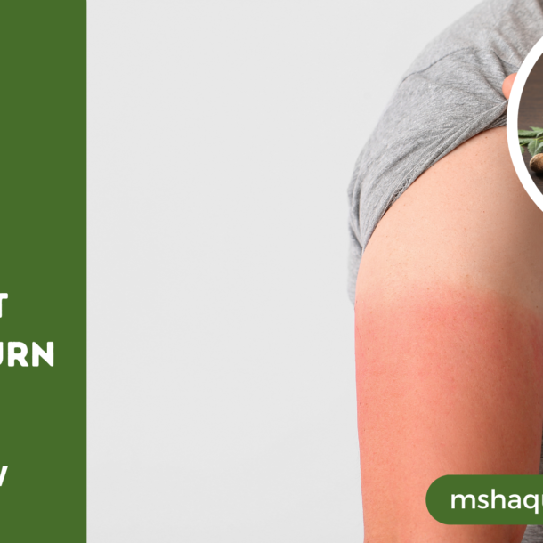 Best Herbal Treatment For Sunburn