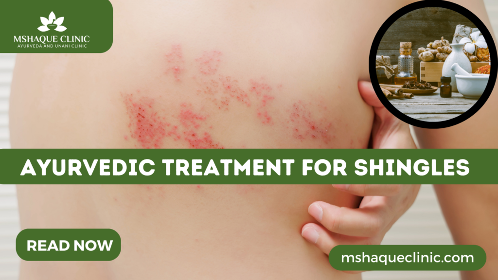 Ayurvedic Treatment For Shingles
