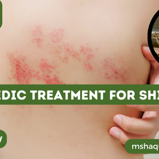 Ayurvedic Treatment For Shingles