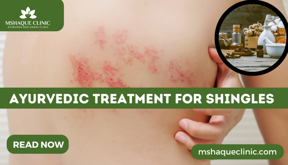 Ayurvedic Treatment For Shingles