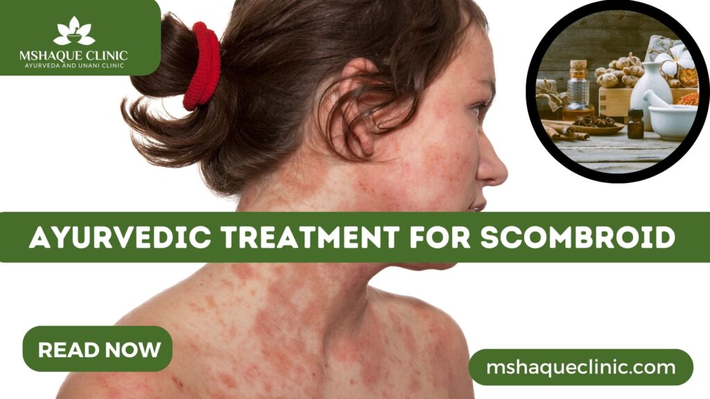 Ayurvedic Treatment For Scombroid
