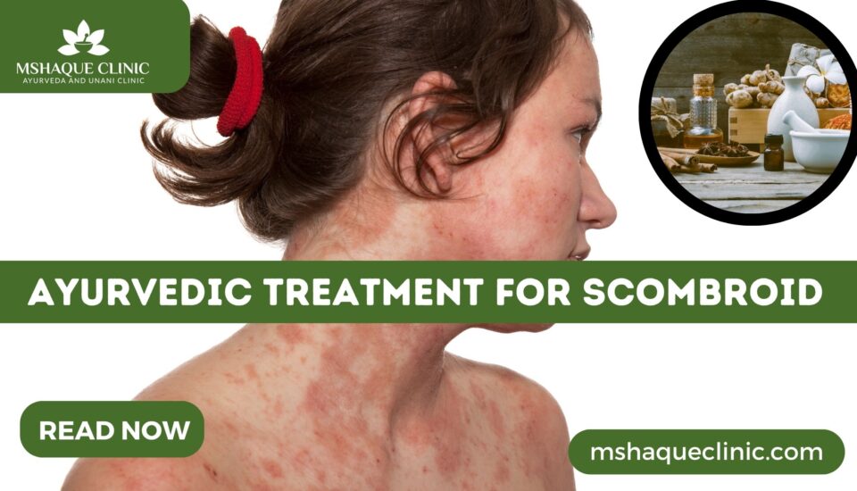 Ayurvedic Treatment For Scombroid