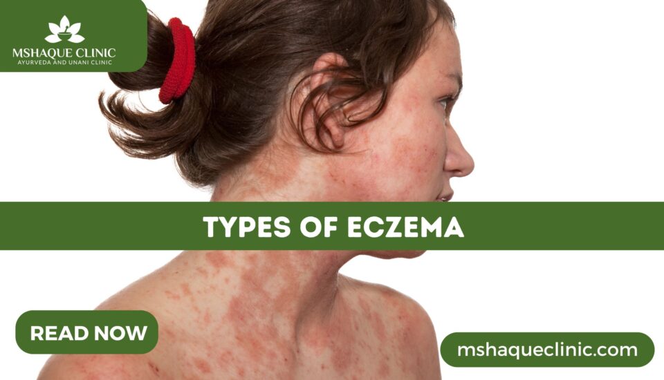 Types Of Eczema