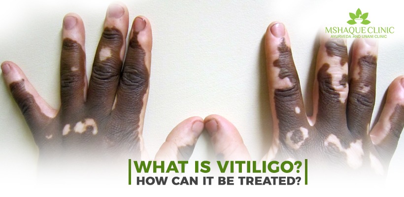 What is vitiligo? How can it be treated? | MSHaque Clinic