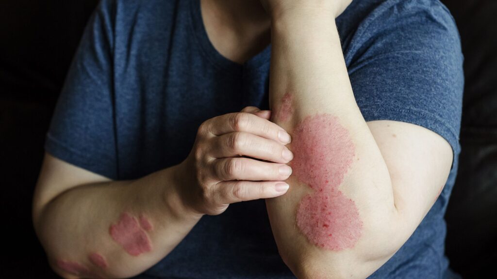 Ayurvedic Skin Treatment