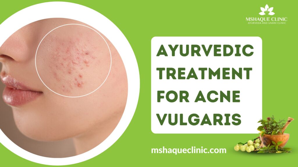 ayurvedic treatment for acne vulgaris