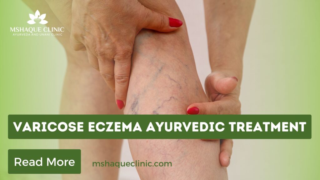 Varicose Eczema Ayurvedic Treatment