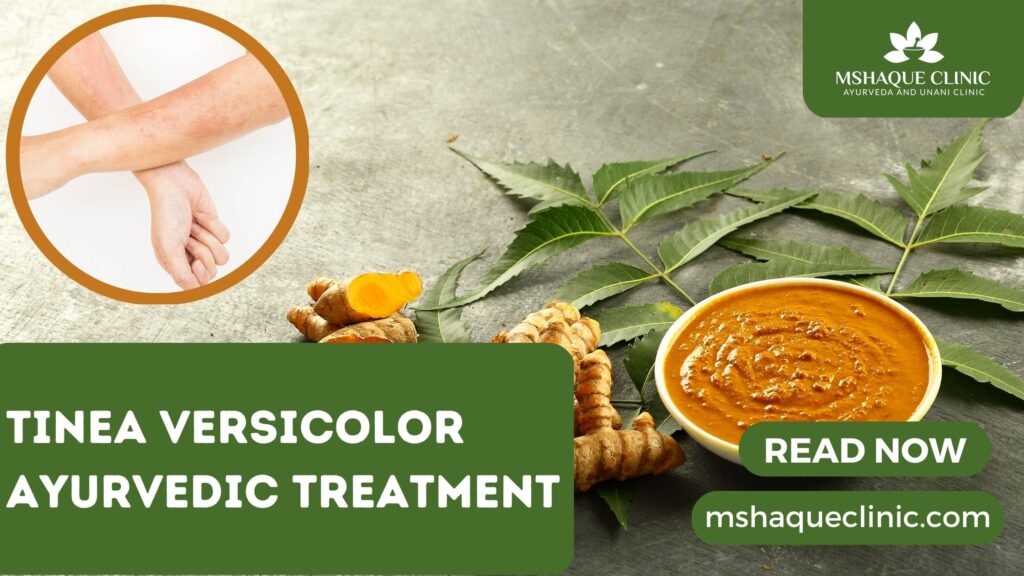 Tinea Versicolor Ayurvedic Treatment