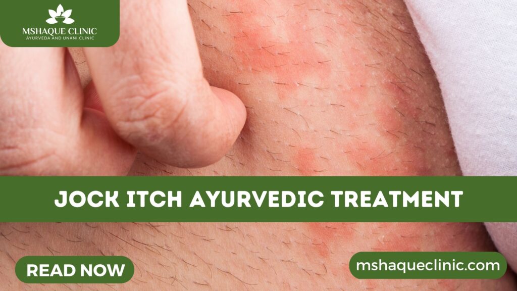 Jock Itch Ayurvedic Treatment