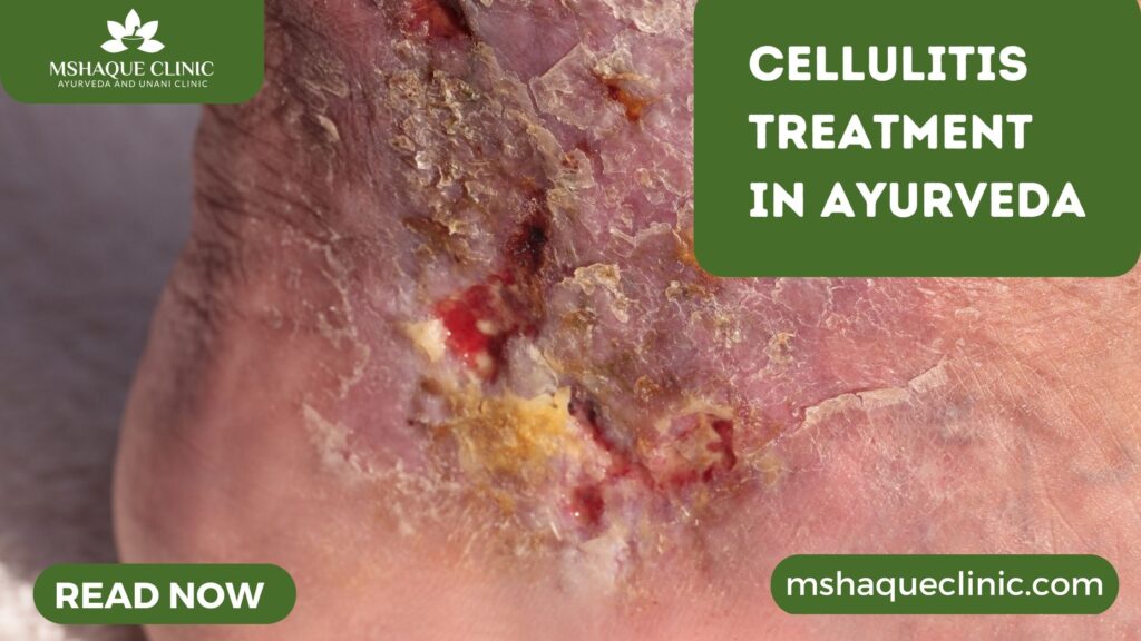 Cellulitis Treatment In Ayurveda