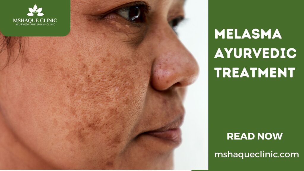 Melasma Ayurvedic Treatment