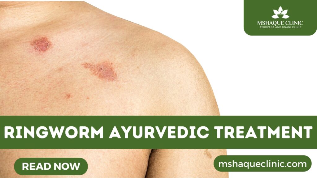Ringworm Ayurvedic Treatment