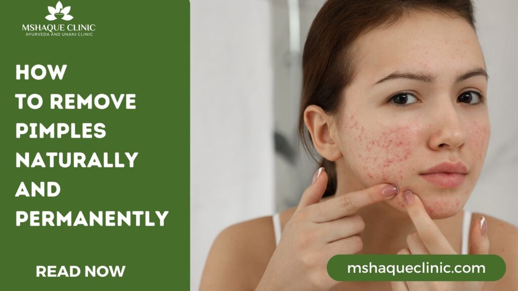 How To Remove Pimples Naturally And Permanently