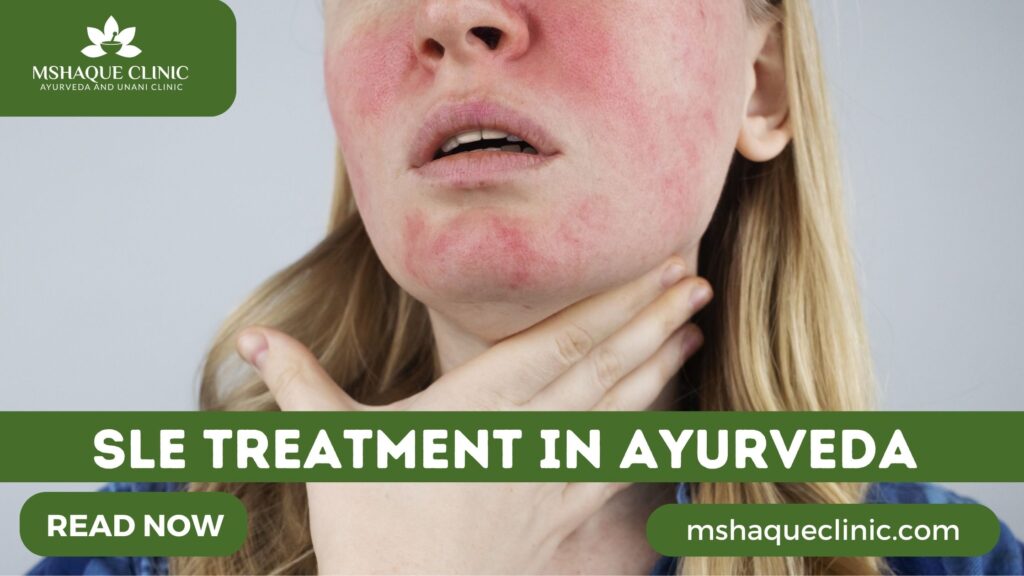 Sle Treatment In Ayurveda