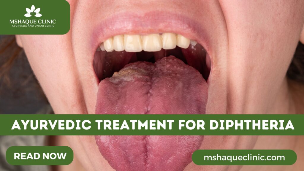 Ayurvedic Treatment For Diphtheria