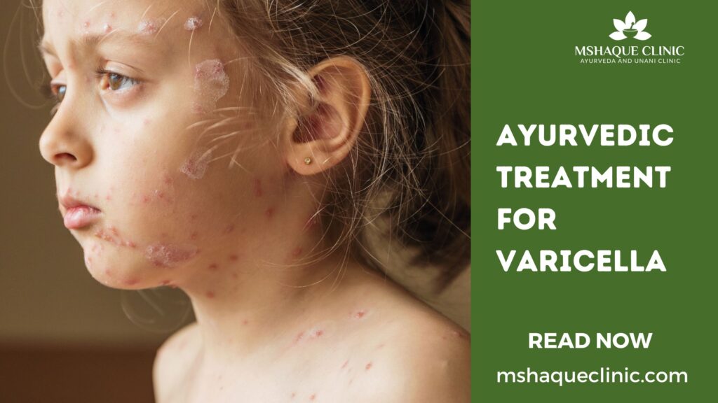 Ayurvedic Treatment For Varicella