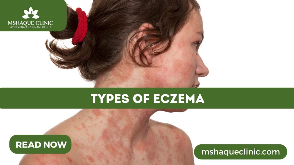 Types Of Eczema